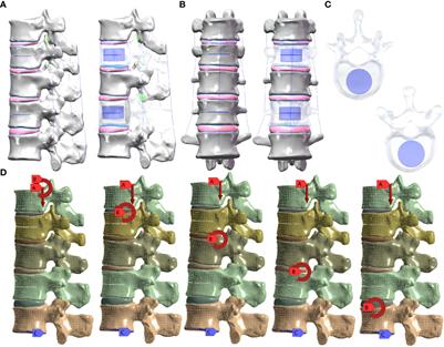 Biomechanical analysis of sandwich vertebrae in osteoporotic patients: finite element analysis